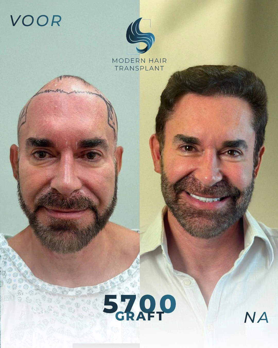 natural-hair-transplant-results-before-after-modern-haar-clinic