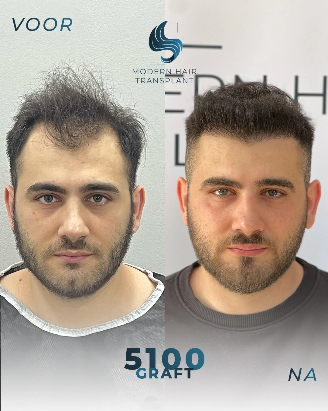 natural-hair-transplant-results-before-after-modern-haar-clinic