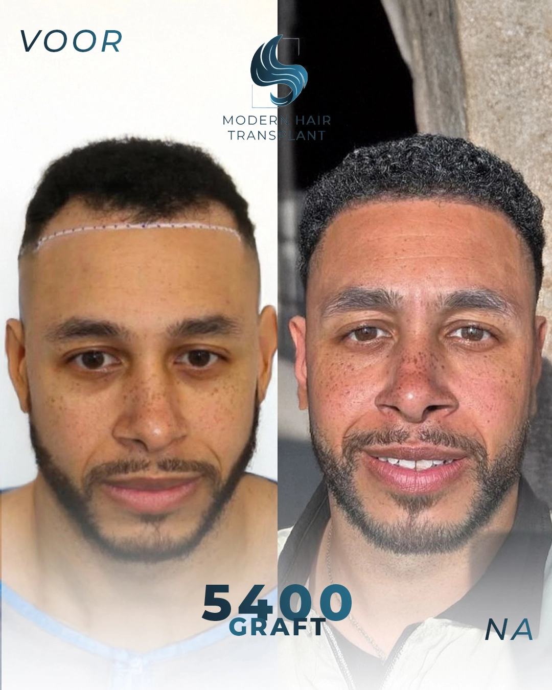 natural-hair-transplant-results-before-after-modern-haar-clinic