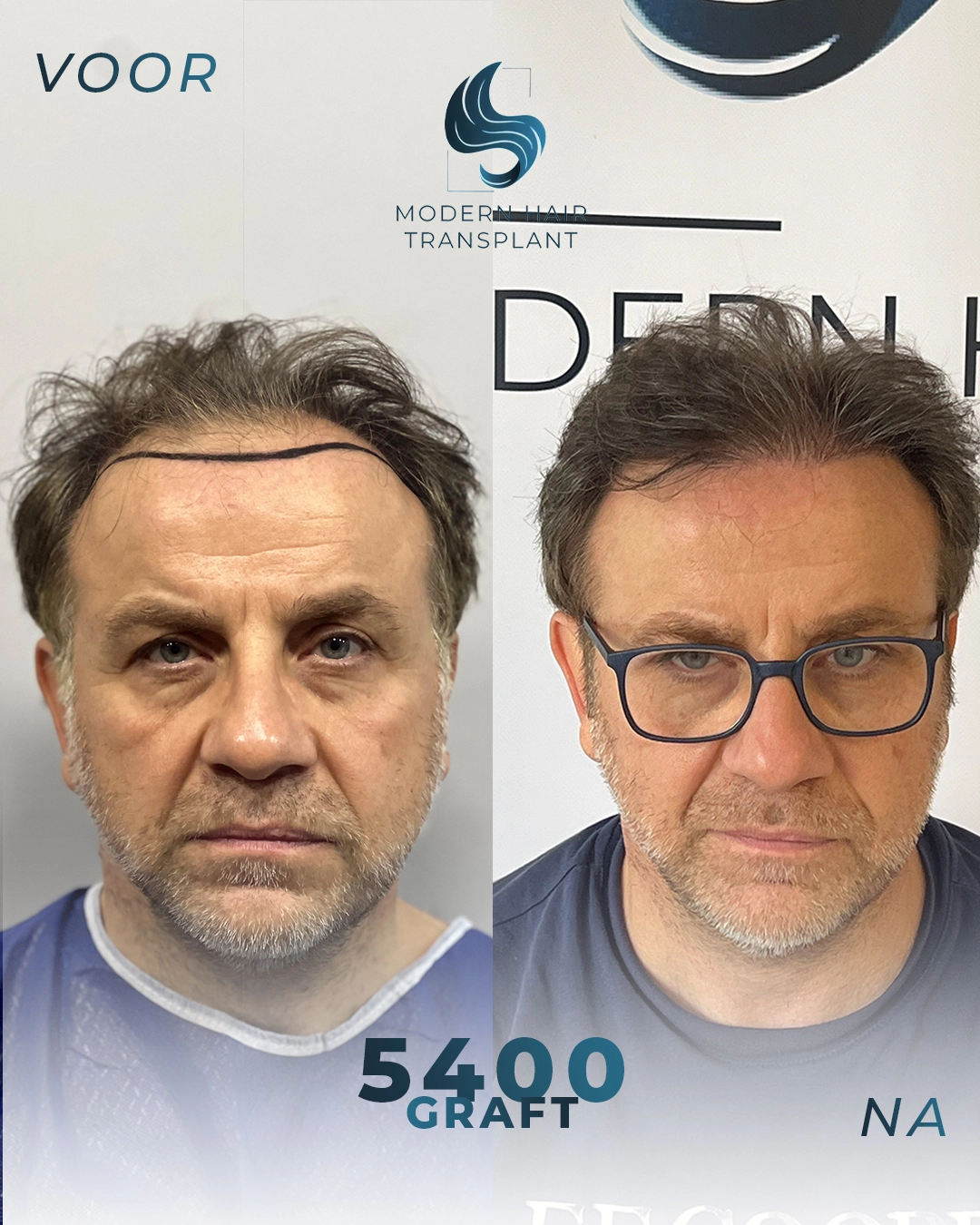 natural-hair-transplant-results-before-after-modern-haar-clinic
