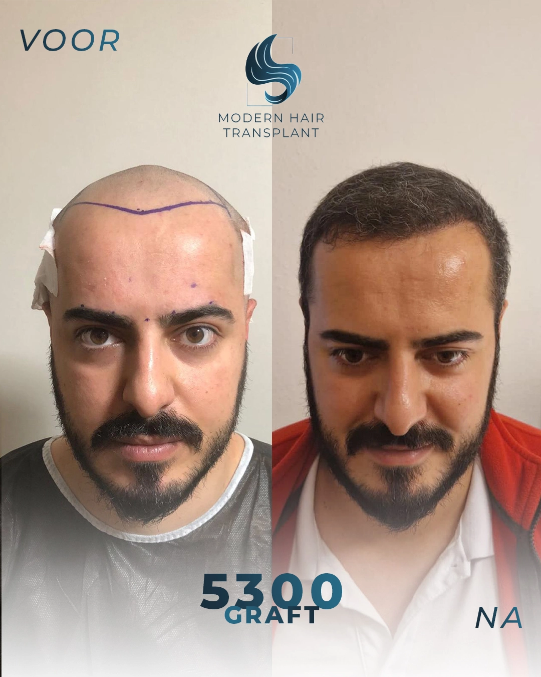 natural-hair-transplant-results-before-after-modern-haar-clinic