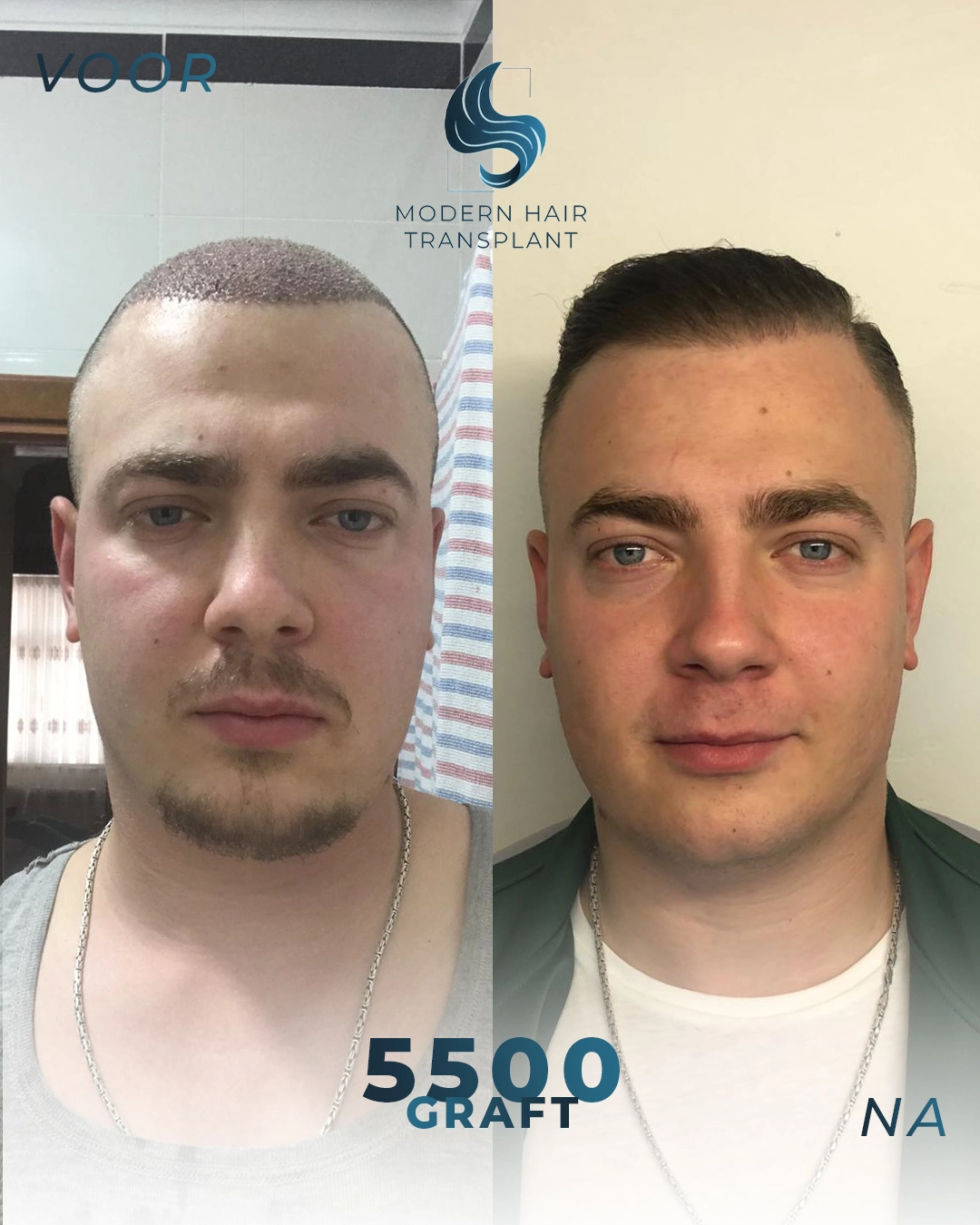 natuurlijke-haartransplantatie-resultaten-voor-en-na-rijswijk