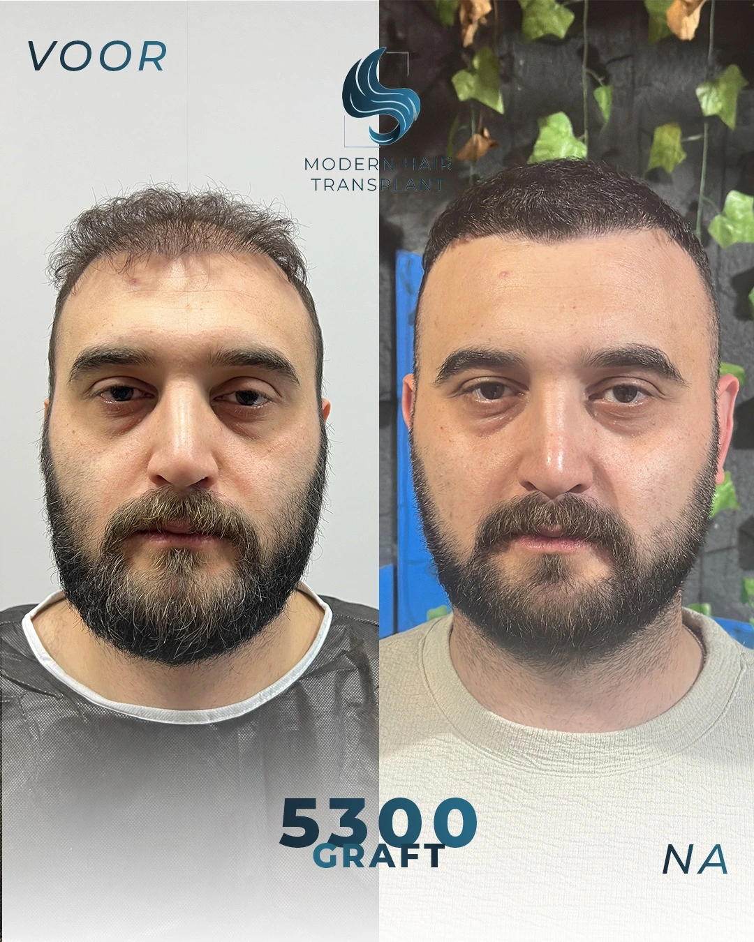 natuurlijke-haartransplantatie-resultaten-voor-en-na-rijswijk