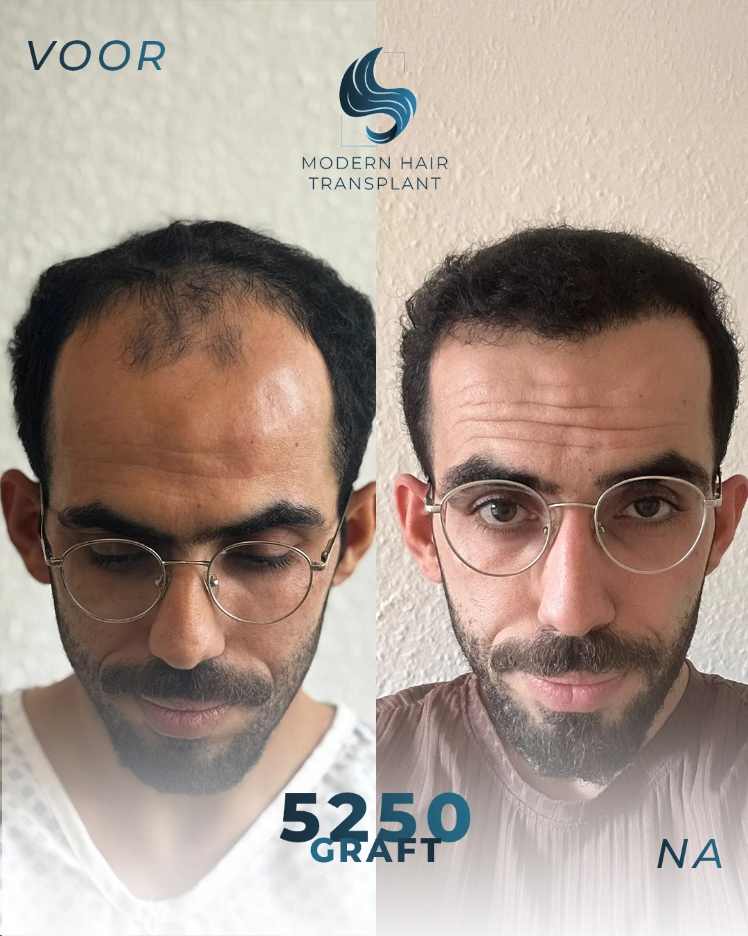 natuurlijke-haartransplantatie-resultaten-voor-en-na-rijswijk