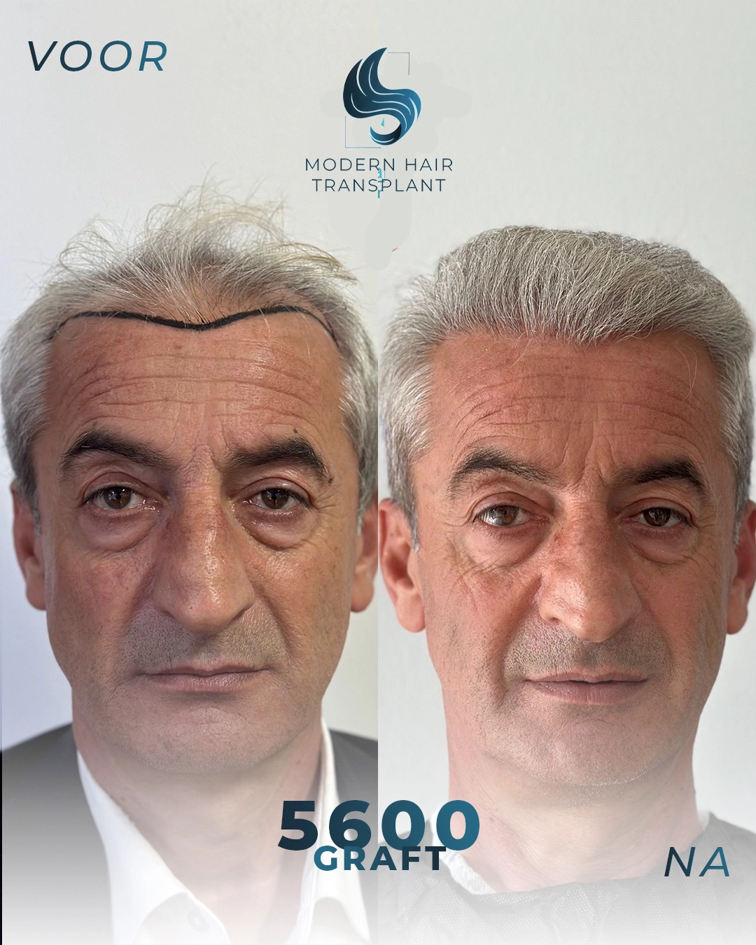 natuurlijke-haartransplantatie-resultaten-voor-en-na-rijswijk