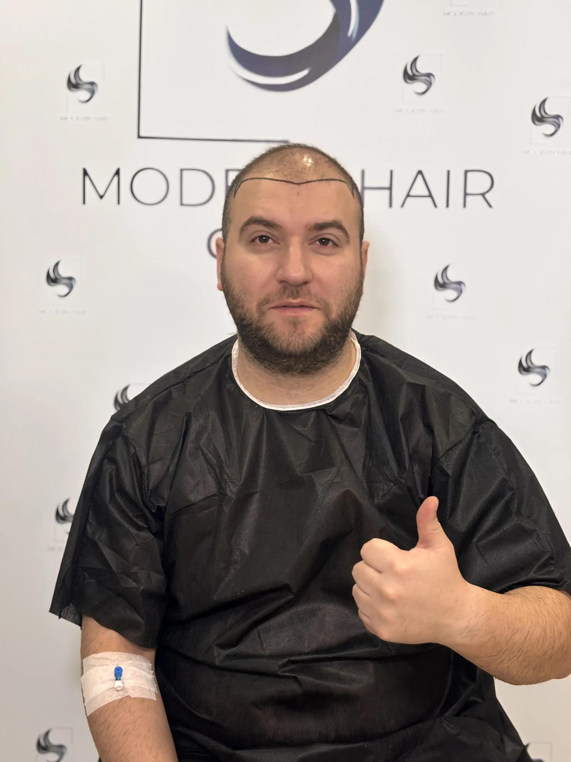 natural-hair-transplant-results-before-after-modern-haar-clinic